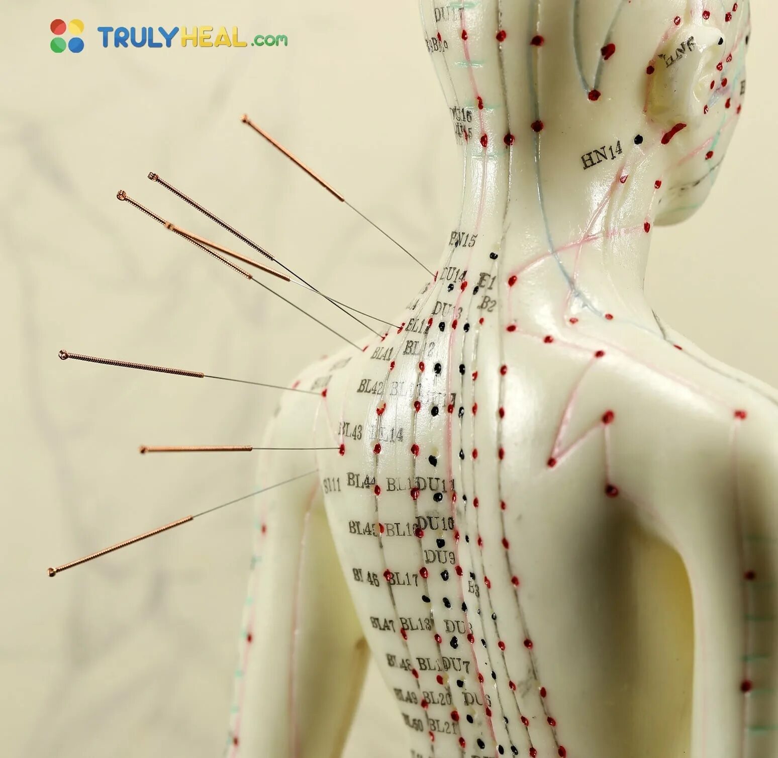 Иглоукалывание иглонож. Иглонож. Иглонож в китайской медицине. Китайская методика иглонож. Иглоукалывание иглонож.