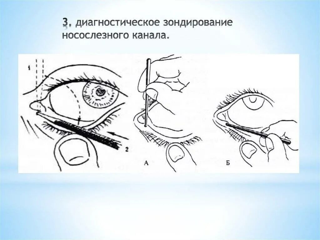 Массаж глаз слезного канала. Непроходимость слезных путей операция. Зондирование слезного канальца. Операция на хронический дакриоцистит. Закупорка слезного слезной железы.