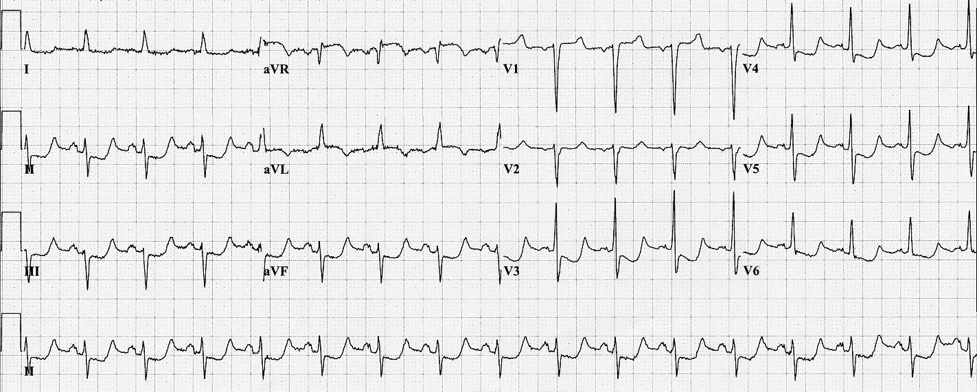 St ишемия. Ишемия субэндокарда на ЭКГ. Субэпикардиальная ишемия на ЭКГ. ЭКГ при субэпикардиальном повреждении миокарда. Ишемия миокарда на ЭКГ.
