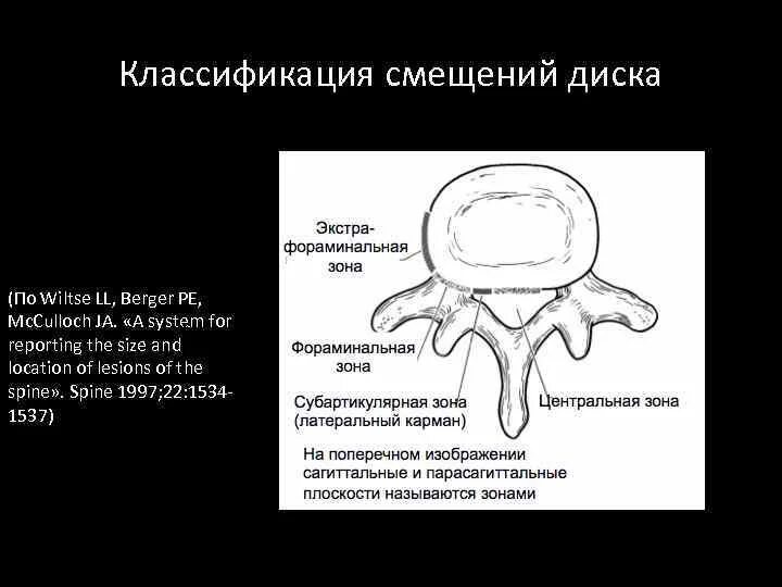 Медианно парамедианная протрузия диска. Фораминальная экструзия диска что это. фораминальная грыжа. фораминальные отверстия. субартикулярно-фораминальная экструзия.