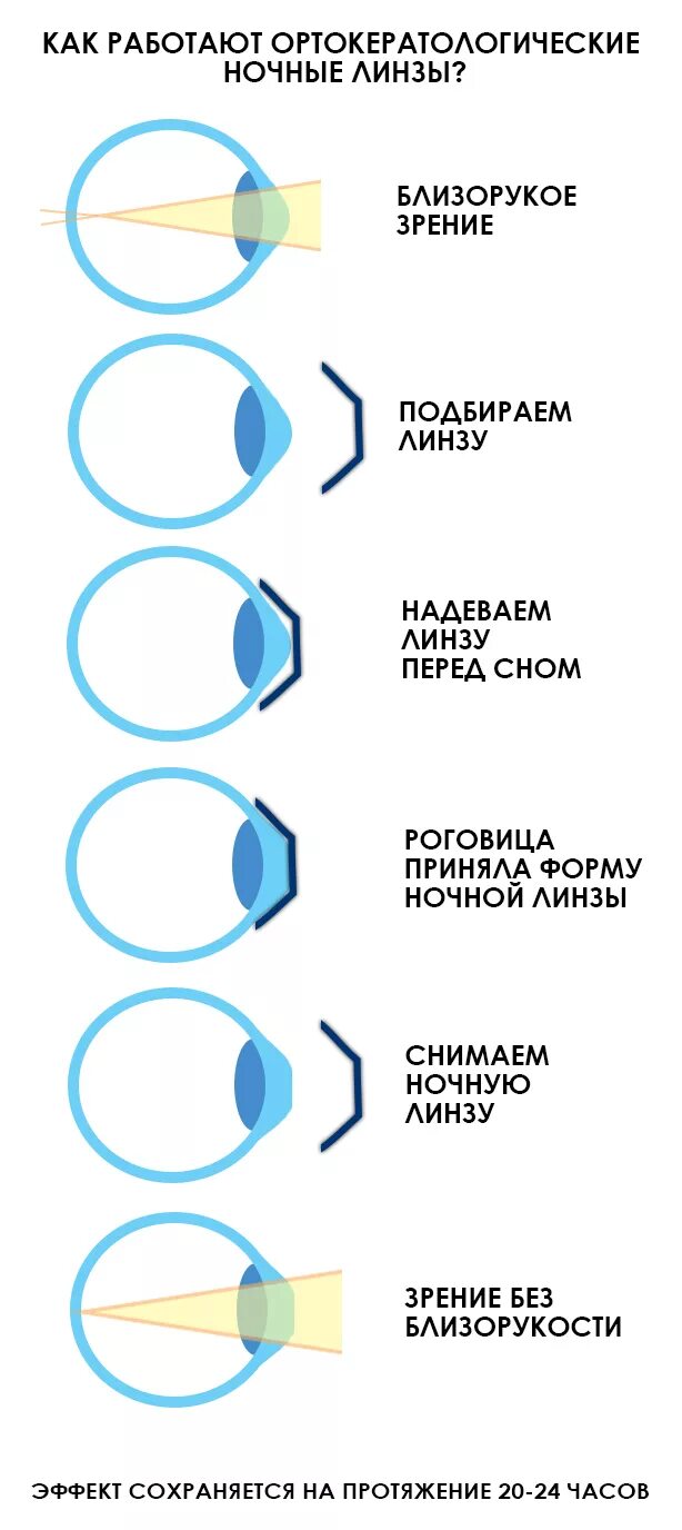 Ночные линзы для восстановления зрения детям отзывы. Ночные контактные линзы. Октореалогические линзы. Коррекция зрения контактными линзами. Линзы ночные для коррекции зрения.