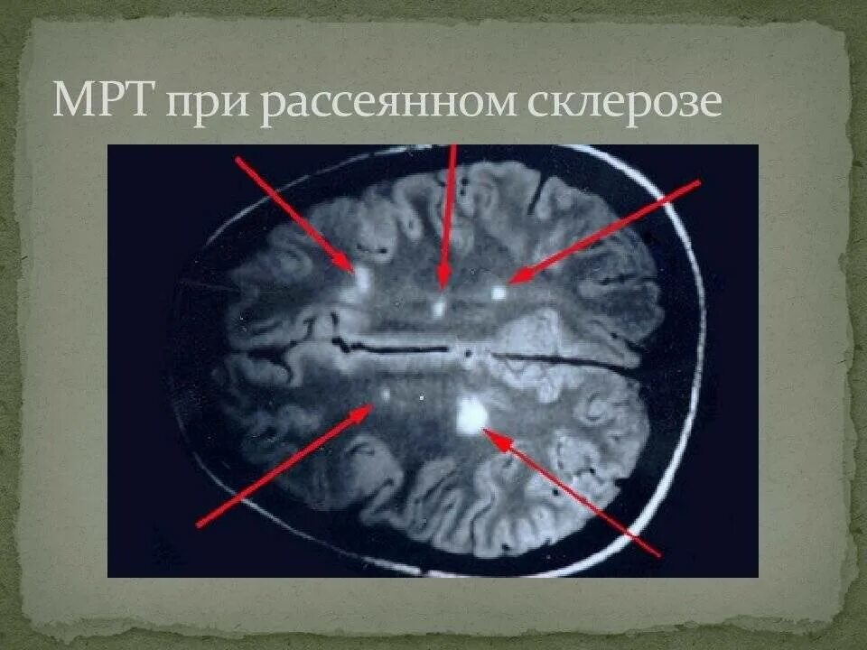 Склероз мозга. Мрт очаги поражения рассеянный склероз. Очаги рассеянного склероза на мрт. Мрт при рассеянном склерозе. Очаги при рассеянном склерозе мрт.