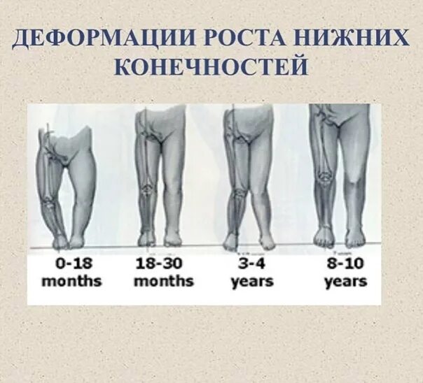 Вальгус у детей как выглядит Фото ВАЛЬГУСНАЯ СТОПА СТЕПЕНИ