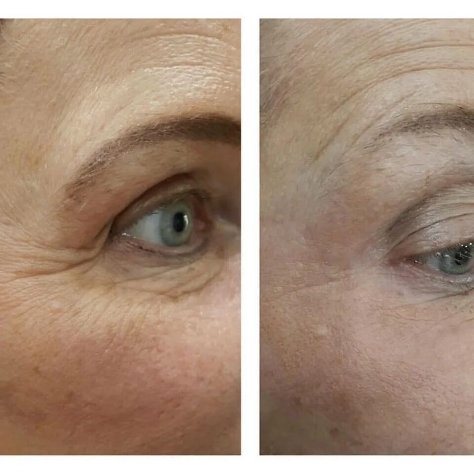 Jett Plasma Lift Medical. Фибропласт плазма лифтинг. Блефаропластика Plasma Liner. Плазменная подтяжка