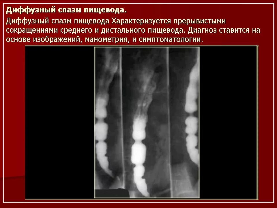 Диффузный эзофагоспазм. Дивертикул пищевода рентген. непроходимость пищевода на рентгене. сегментарный спазм пищевода рентген. диффузный спазм пищевода рентген.