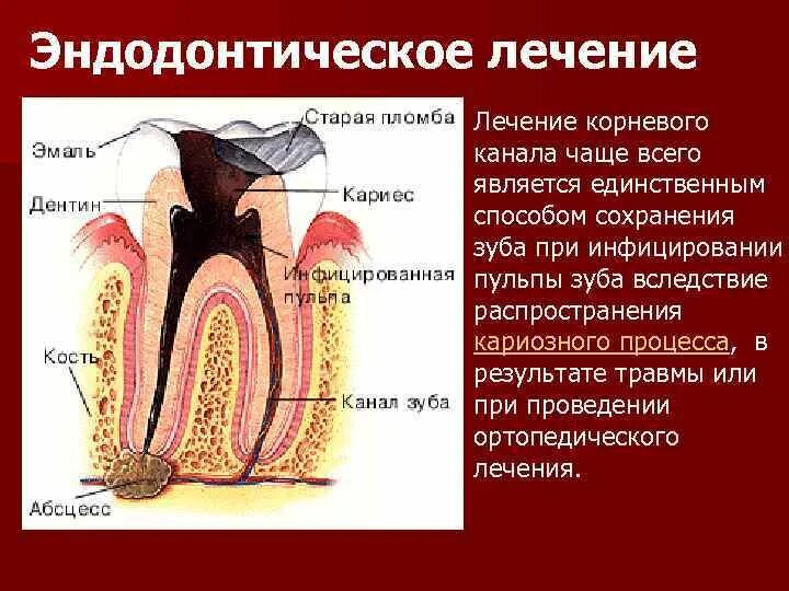 Восстановление после эндодонтического лечения. Лечение корневых каналов. Эндолечение зуба этапы. Ошибки и осложнения при пломбировании корневых каналов. Этапы эндодонтической обработки корневых каналов.