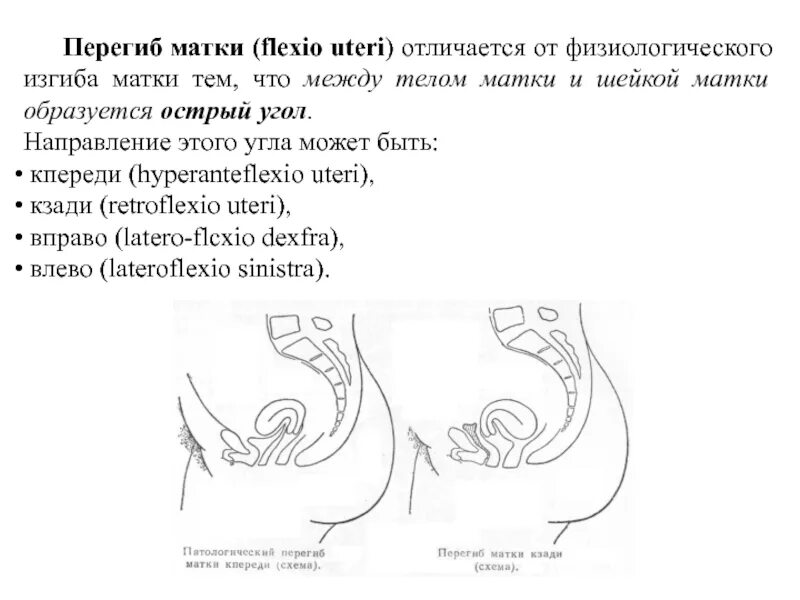 Расположение матки кзади. Изгиб шейки матки кзади. Матка в антефлексио при беременности на ранних сроках. Расположение шейки матки кзади.