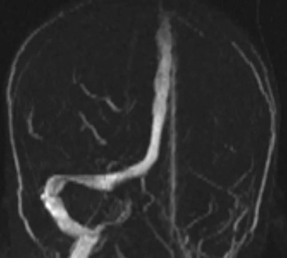 Тромбоз артерии мозга. Тромбоз сигмовидного синуса на кт. Тромбоз поперечного синуса мрт. Тромбоз синусов головного мозга кт. Тромбоз поперечного синуса головного мозга на кт.