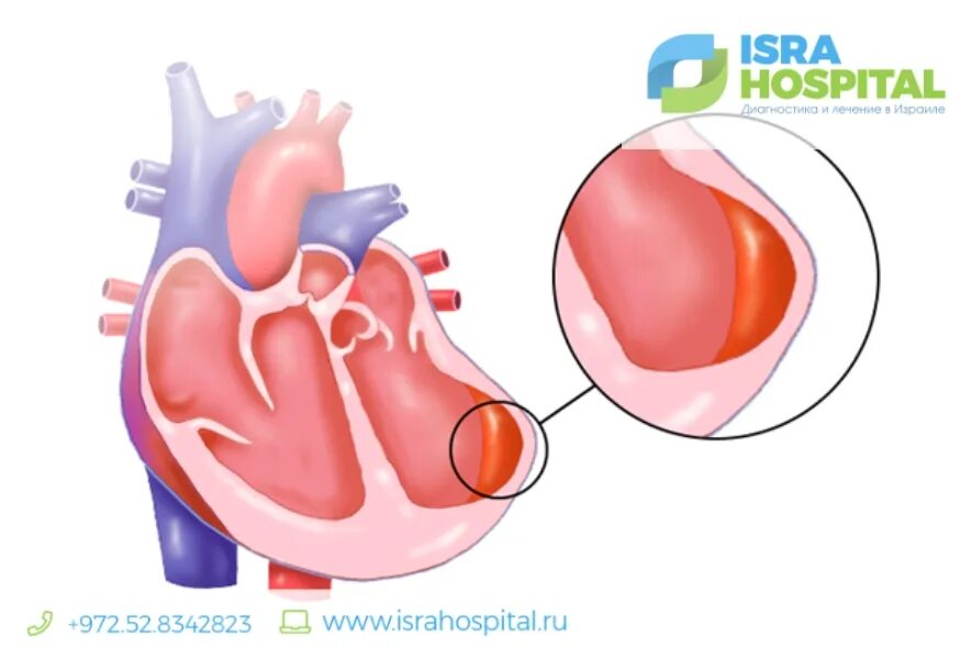 Постинфарктная аневризма. Аневризма левого желудочка сердца после инфаркта миокарда. Аневризма сердца стенки левого желудочка. Верхушечная аневризма левого желудочка. Тромб в желудочке