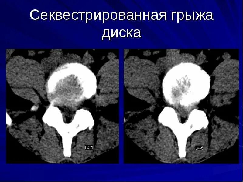 Грыжи на кт. Секвестрация грыжи диска. секвестрированная грыжа позвоночника на кт.