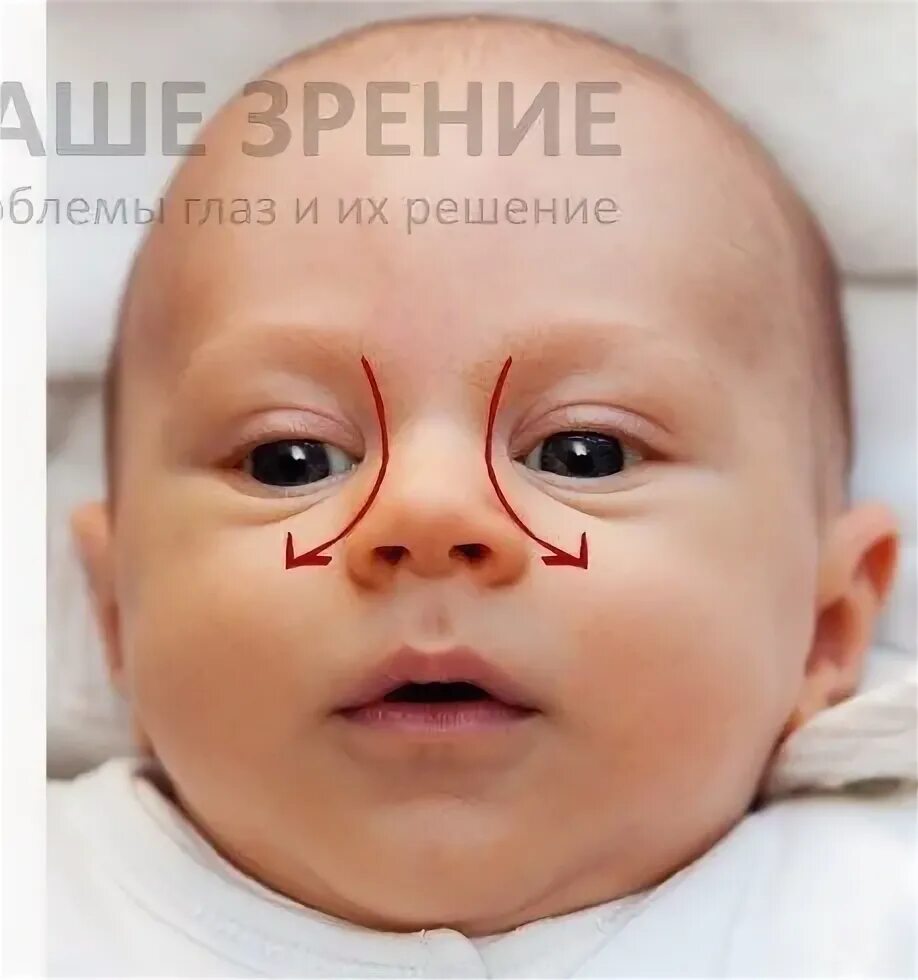 Дакриоцистит как делать массаж. Дакриоцистит новорожденных офтальма. зондирование слезного канала у детей. дакриоцистит массаж слезного канала у новорожденных. зондирование глаза слезного канала.