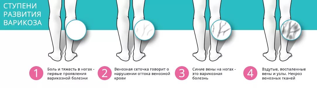 Утром болят ноги причины. Ступени развития варикоза. Профилактика варикозной болезни. Варикозное расширение вен степени тяжести. Болят ноги тяжесть в ногах.