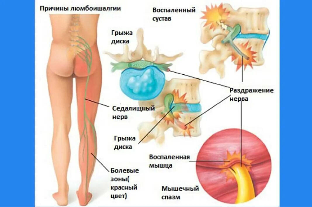 Защемление нерва в спине поясница. Межпозвоночная грыжа седалищного нерва. Люмбоишиалгия поясничного отдела позвоночника. Воспалённый седалищный нерв. Синдром поражения седалищного нерва.