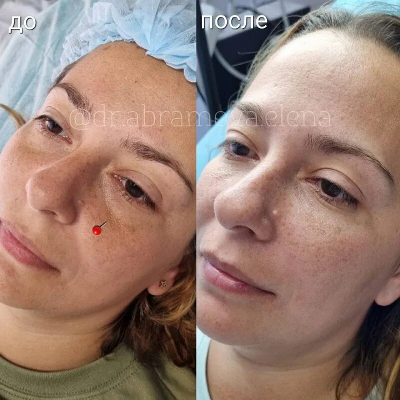 носослезная борозда коррекция филлерами. скулы и носослезной борозды. коррекция носощечной борозды филлерами. теосиаль 2 носослезная борозда. носощечные борозды.