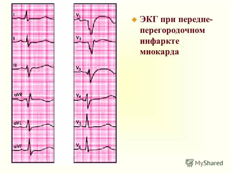 Изменение миокарда передне перегородочной области. Инфаркт переднеперегородочной области на ЭКГ. Передне-перегородочный инфаркт миокарда на ЭКГ. Инфаркт миокарда ЭКГ передней стенки q. ЭКГ передне перегородочный инфаркт миокарда левого желудочка.