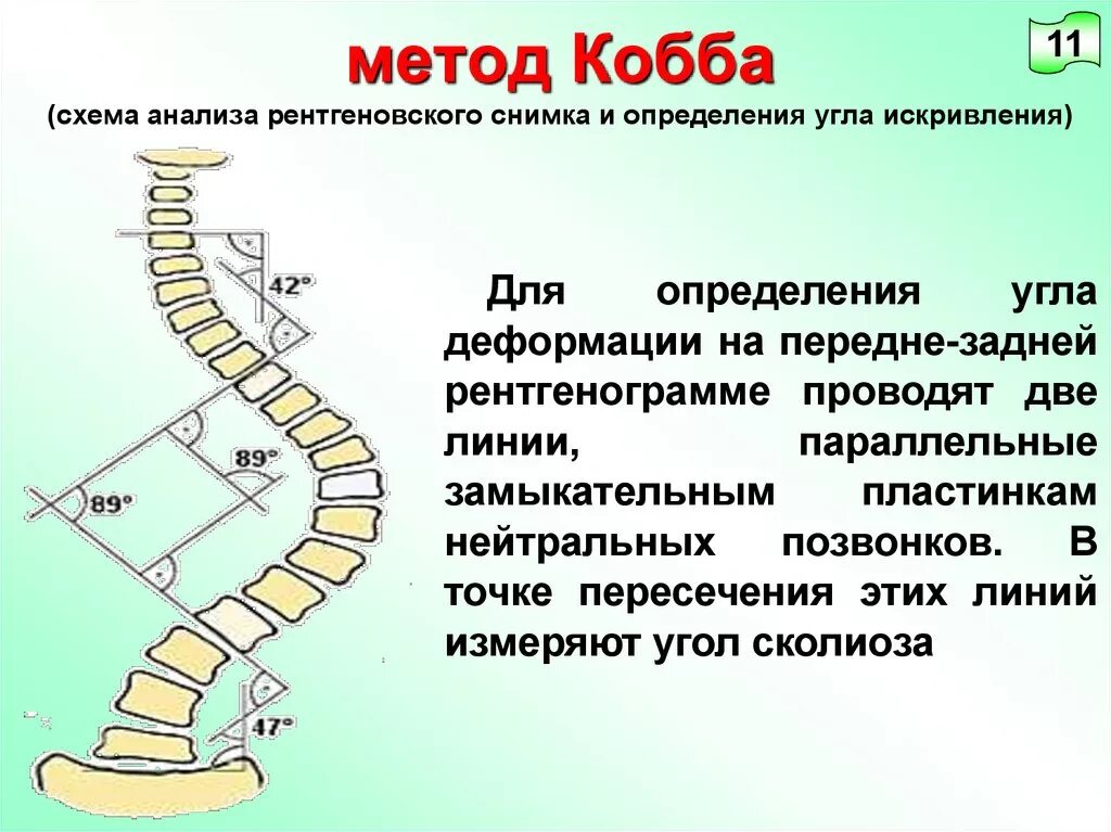 Метод Кобба сколиоз степени. Степени искривления позвоночника по коббу. Угол Кобба степени сколиоза. Измерение угла сколиоза по коббу. Угол кобба