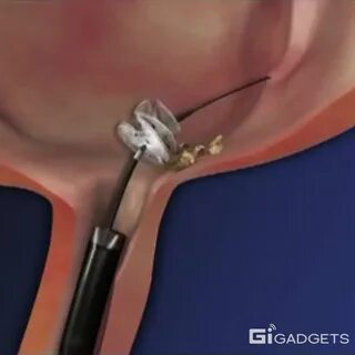 Удалить камни быстро