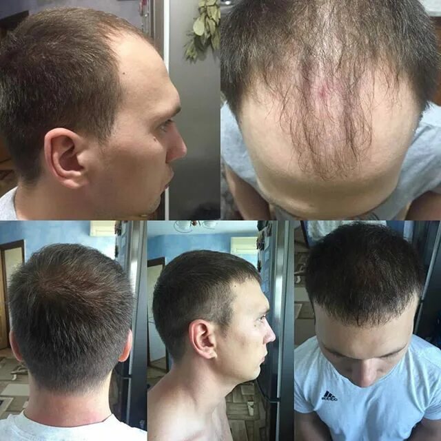 Донорская зона после пересадки. Пересадка волос в Турции.