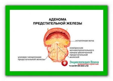 Как лечить аденому простаты просто и быстро