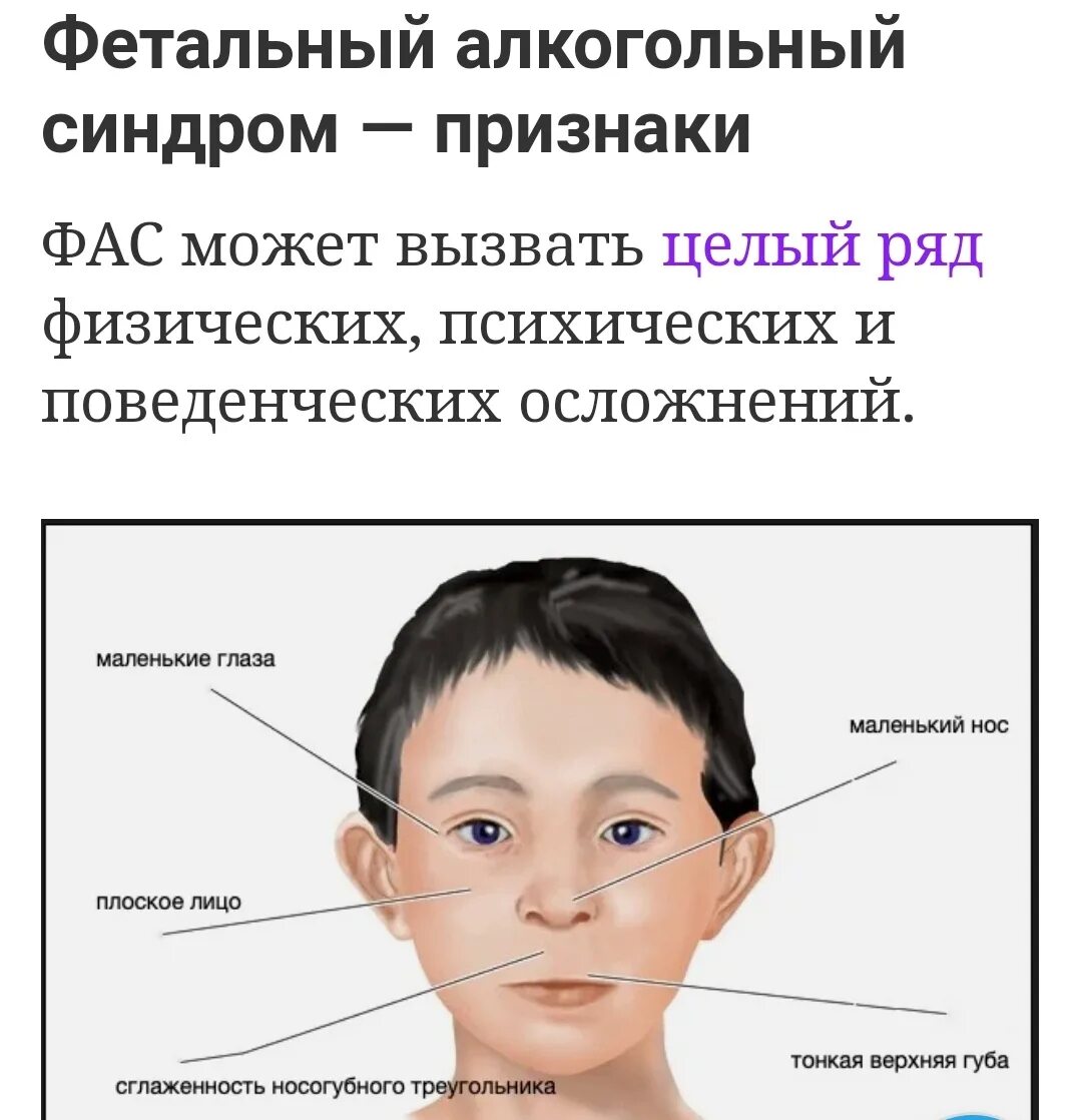 Фетально алкогольный синдром. Фетальный алкогольный синдром. Фетальный алкогольный синдром у детей внешние признаки. Фета алкогольный синдром. Футбольный алкогольный синдром.