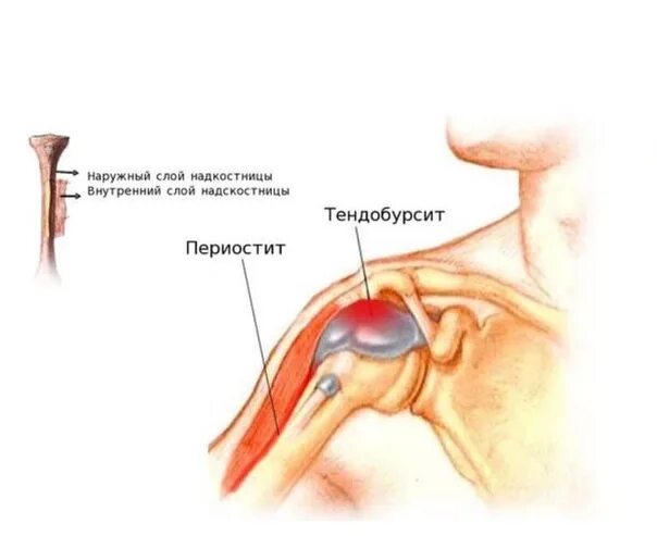 Плечевой периартрит что это. Синдром плечелопаточный периартрит. Плечелопаточный периартрит плечевого сустава. Суставной капсулит плечевого сустава. Плечелопаточный периартрит периартроз.