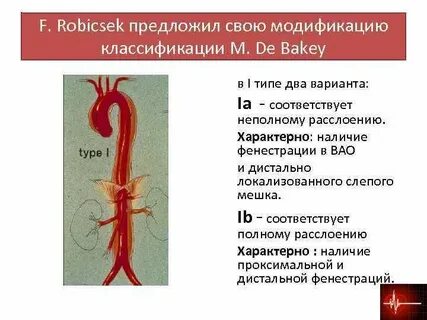 Кальцинированная аорта