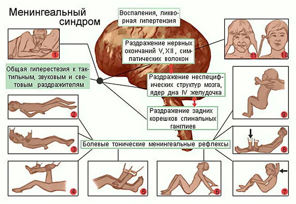 Последствия менингита у взрослых