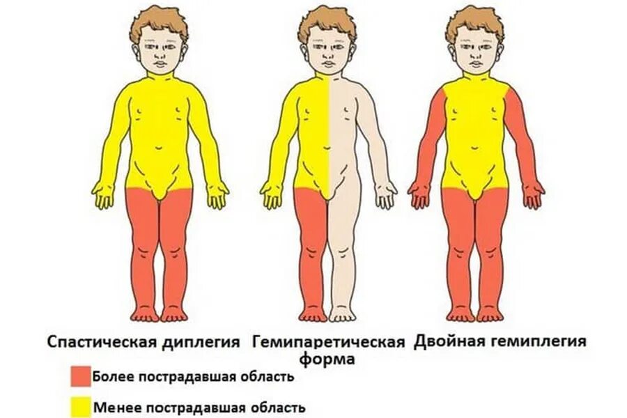 Спастическая диплегия форма ДЦП. Гемипаретическая форма ДЦП симптомы. ДЦП легкая форма симптомы. ДЦП формы спастическая гемиплегия. И легкой форме данной