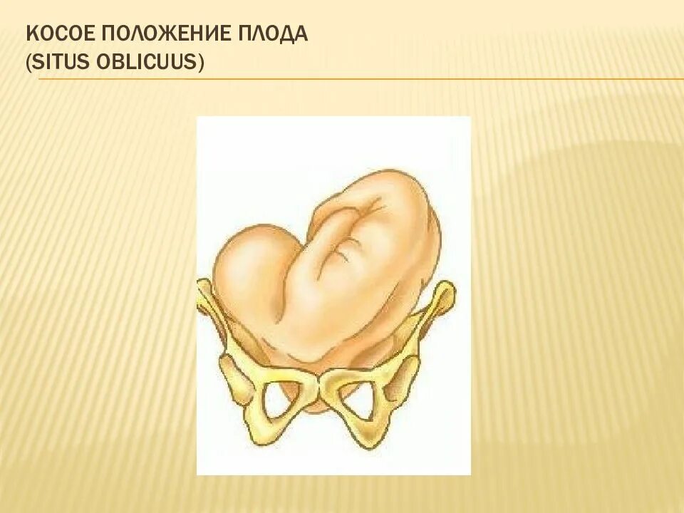 Косое положение плода. Расположение плода с позициями. косое положение плода позиция. не правильная позиция плода.