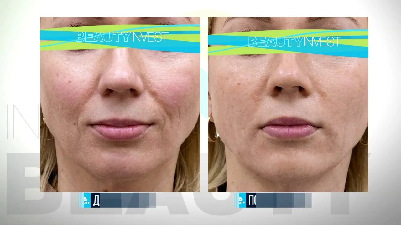 Бланширование морщин белотеро. Бланширование морщин белотеро софт. Бланширование морщин до и после. Бланширование морщин белотеро софт. Белотеро софт бланшинг.