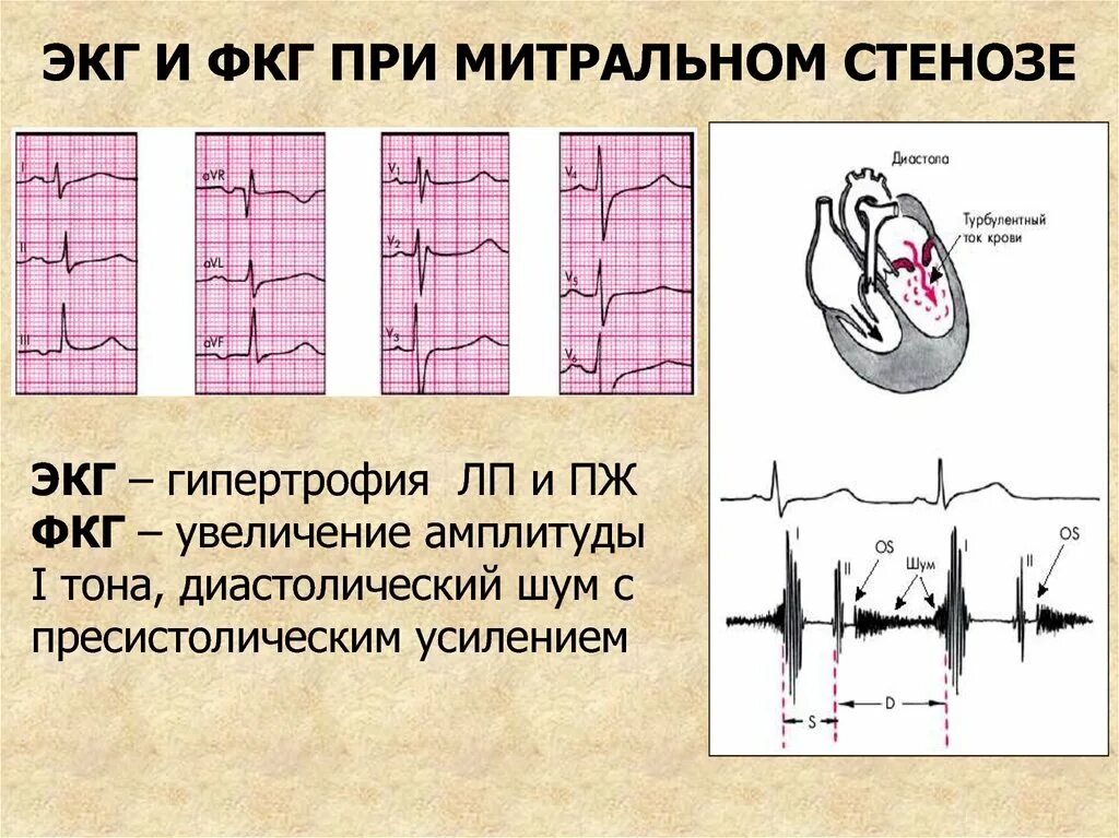 Стеноз митрального клапана ЭКГ. ЭКГ при стенозе митрального клапана. ЭКГ признаки митрального стеноза. Изменения на ЭКГ при митральном стенозе. Митральный стеноз признаки