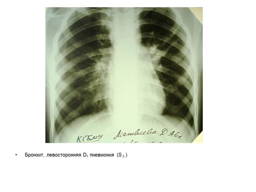 Правосторонняя бронхопневмония рентген. Бронхопневмония у детей рентген. Левосторонняя бронхопневмония. Левосторонняя s3 пневмония это.