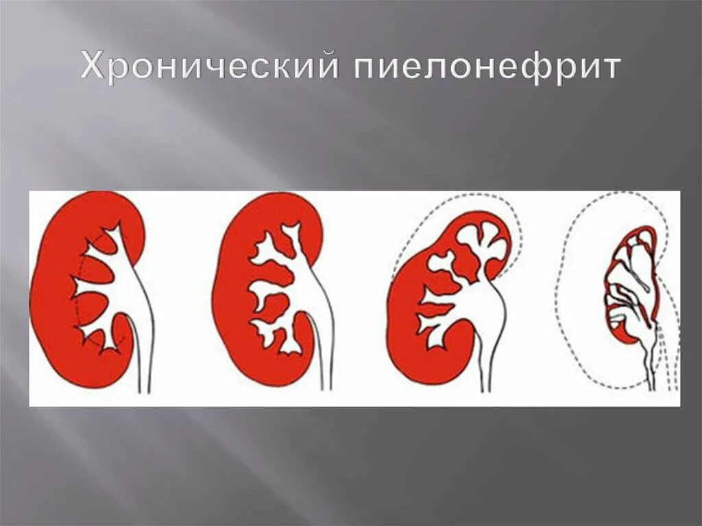 Неполное удвоение почки. Удвоение чашечно-лоханочной системы почек. Неполное удвоение ЧЛС. Неполное удвоение ЧЛС почки.