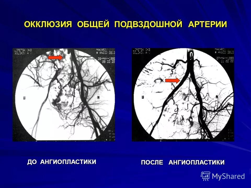 Окклюзия бедренного сегмента. Бедренно-подколенное шунтирование. Окклюзия бедренно-подколенного сегмента сегмента. Окклюзия бедренного сегмента. Артерии подвздошной артерии.