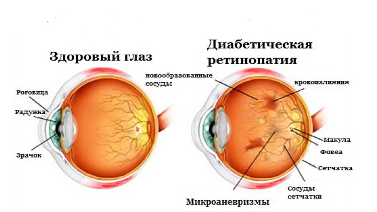 Катаракта глаза при сахарном диабете. Диабетическая ретинопатия сетчатки. осложнения сахарного диабета ретинопатия. препролиферативная диабетическая ретинопатия глазное дно. диабетическая ретинопатия катаракта.