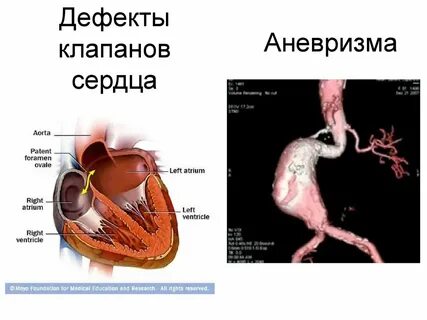 Аневризма сердца