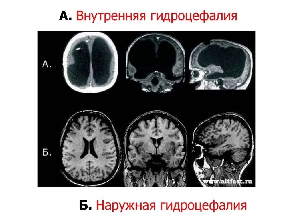 Неокклюзионная гидроцефалия. Наружная викарная гидроцефалия головного. Гидроцефалия головного мозга мрт. Наружная гидроцефалия головного мозга мрт. Наружная и внутренняя гидроцефалия.