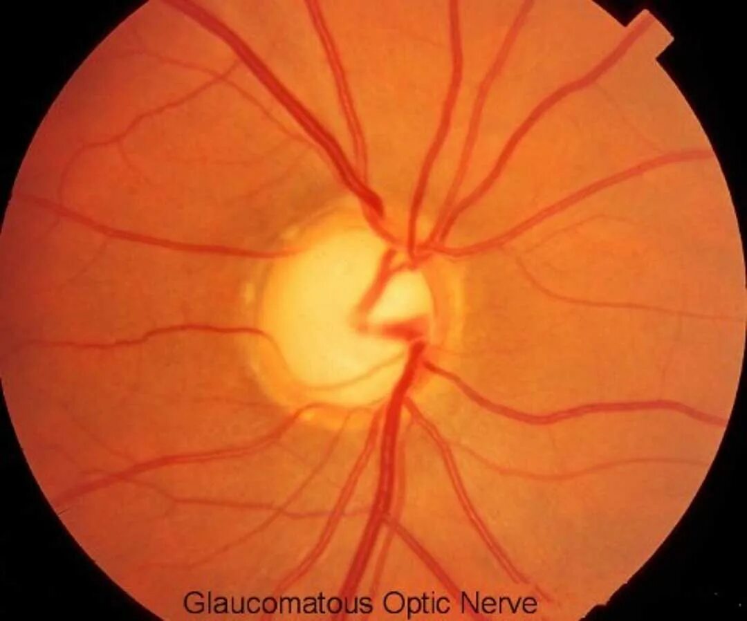 Зрительный нерв при глаукоме. Экскавация диска зрительного нерва. HRT зрительного нерва. Глаукомная экскавация окт.