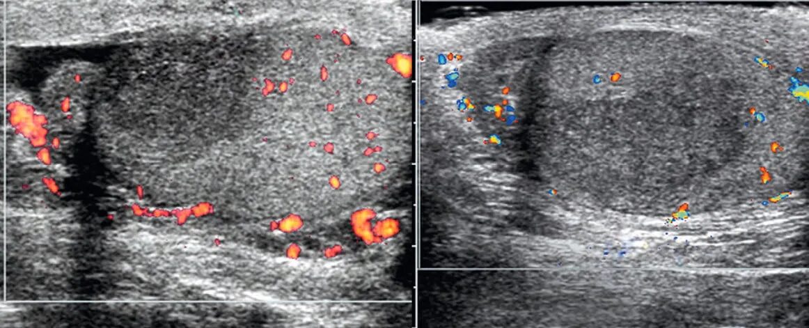 Перекрут гидатиды яичка на УЗИ. Перекрут гидатиды придатка яичка. Перекрут яичка УЗИ картина.