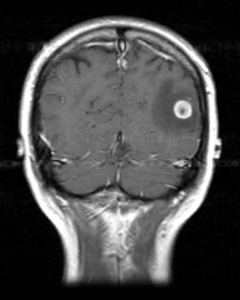 Меланома метастазы в мозг. Метастатические опухоли мозга. Глиобластома головного мозга. Глиобластома головного мозга кт с метастазами.
