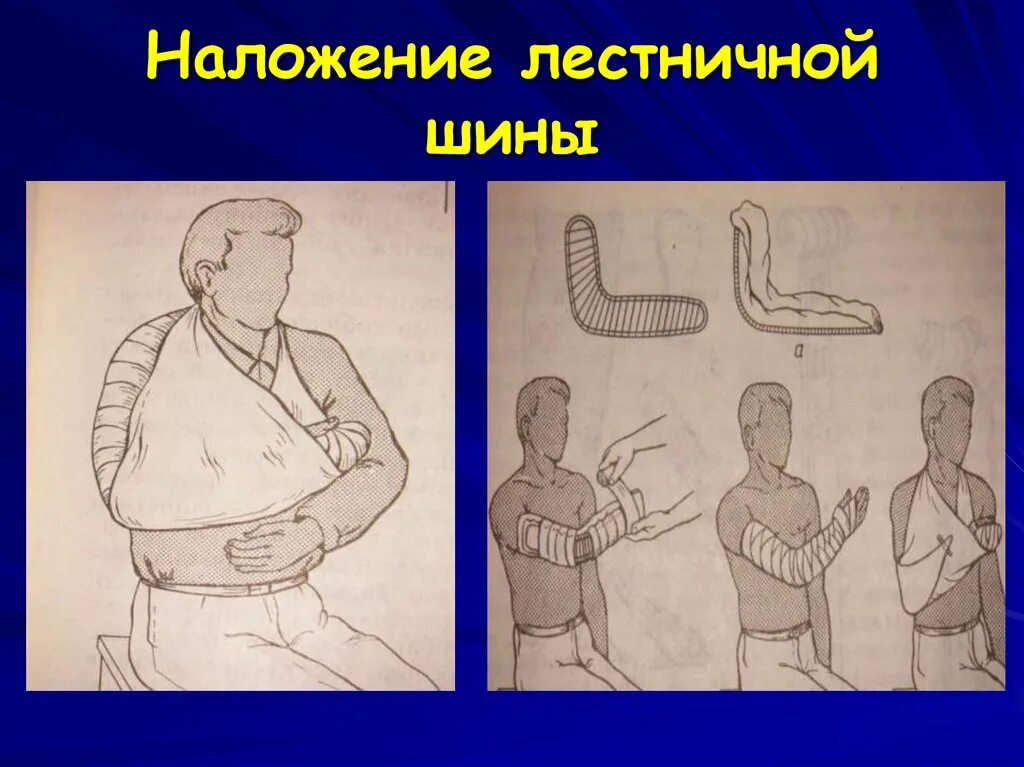 Лестничная шина для иммобилизации. Иммобилизация шиной крамера. лестничные шины для иммобилизации. наложение лестничной шины. лестничная шина крамера.