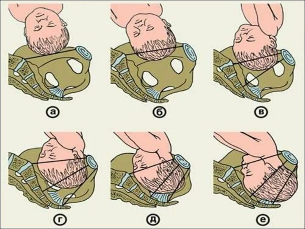 Продвижение по родовым путям. Головка ребенка опустилась в таз. Продвижение головки по родовому каналу. Путь ребенка во время родов