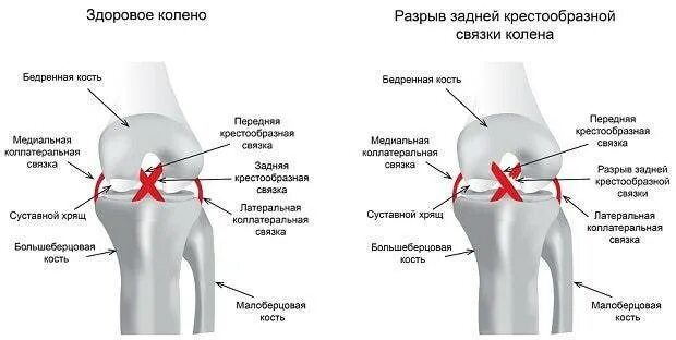 Крестообразные связки коленного сустава симптомы. Разрыв крестовых связок коленного сустава. разрыв передней и задней крестообразной связки коленного сустава. разрыв зкс коленного сустава. степени разрыва крестообразной связки коленного сустава.