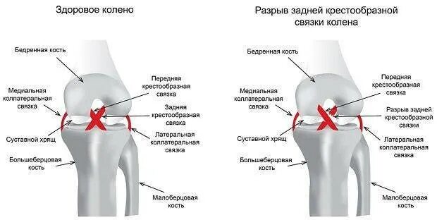 Симптомы крестообразной связки коленного сустава. Разрыв передней крестовой связки коленного сустава. Разрыв передней и задней крестообразной связки коленного сустава. Симптомы повреждения задней крестообразной связки. Разрыв задних крестовых связок коленного сустава.