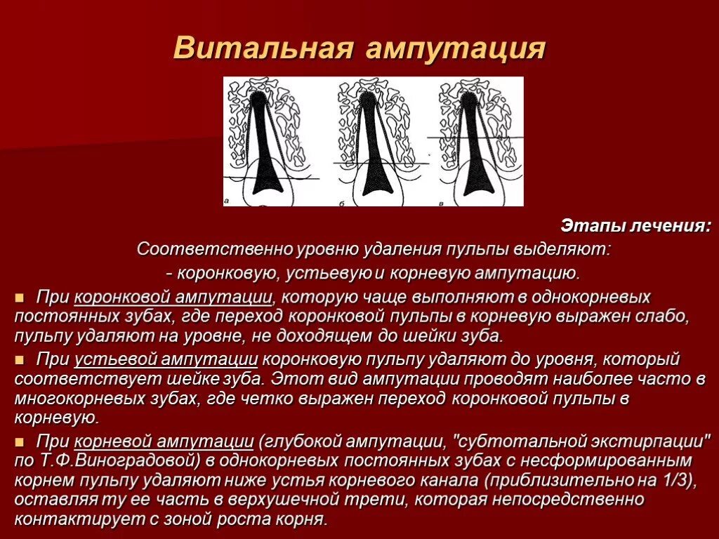 Метод ампутации пульпы. Этапы лечения пульпита методом витальной экстирпации. Витальная ампутация пульпы. Метод витальной ампутации пульпы. Витальная ампутация пульпы этапы.