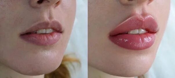 Увлажнение губ до и после. Увлажнение губ аугментация. Увлажнение губ гиалуроновой кислотой.