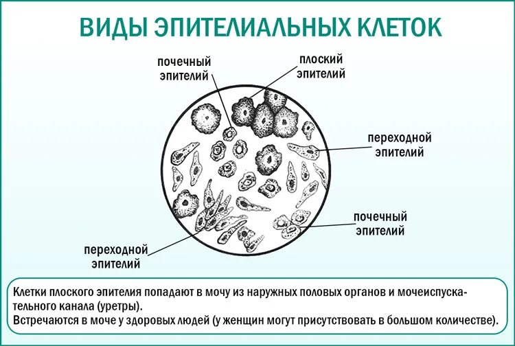 Дрожжевые клетки в моче повышены. Микроскопическое исследование мочи почечный эпителий. Клетки переходного эпителия в моче. Плоский эпителий в моче микроскопия. Микроскопия мочевого осадка. Почечный эпителий.