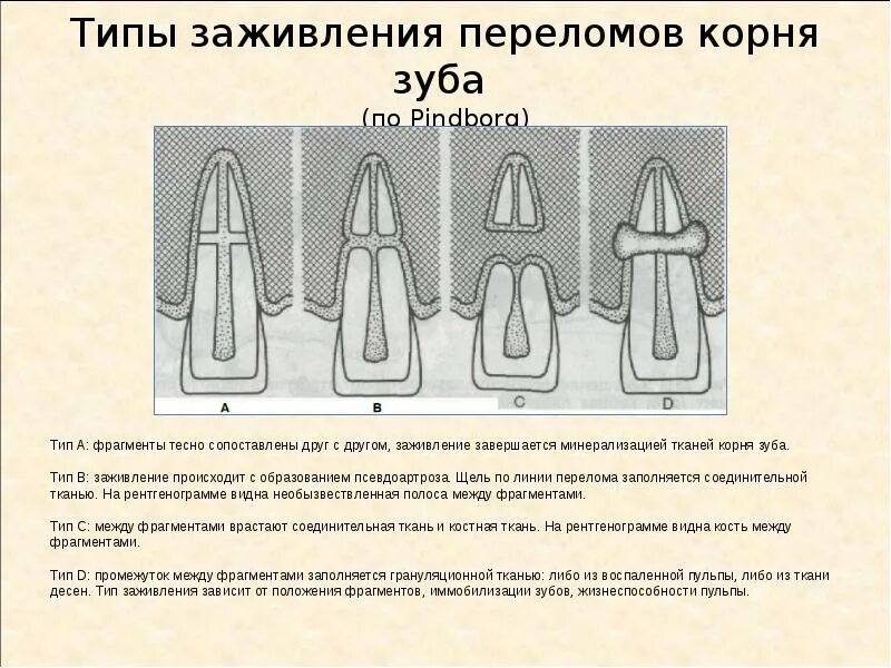 Почему не заживает трещина. Коронково-корневой перелом зуба. Перелом коронки зуба рентген.