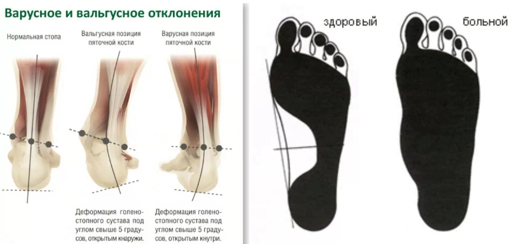 Когда можно ставить на ножки. Плоско вальгусная варусная стопа. Вальгусная стопа и варусная стопа. Вальгус стопы это плоскостопие. Плоско варусная деформация стопы.