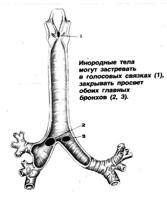 Инородные Тела Трахеи Бронхов